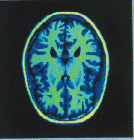 [MRI cross-section of 
brain]